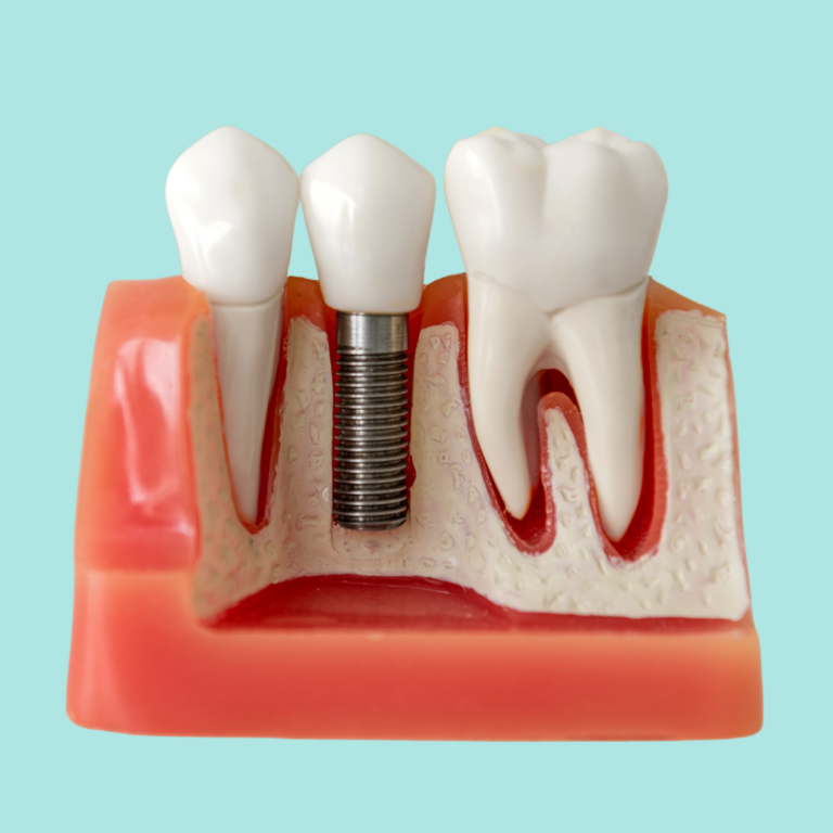 Dental Implants, Missing Teeth