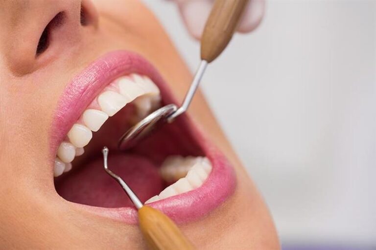 Dental Fillings Penrith