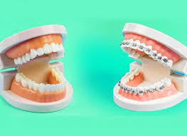 Invisalign vs Traditional Braces